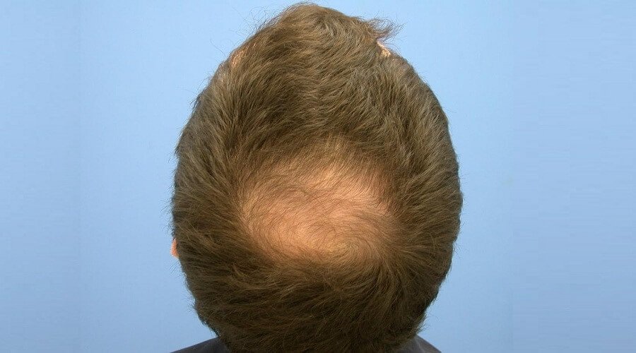 Crown Hair Transplant Dubai: Before Surgery Tips